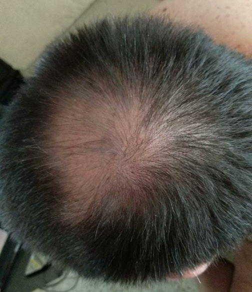 Antes